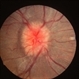 Papilledema Papilledema